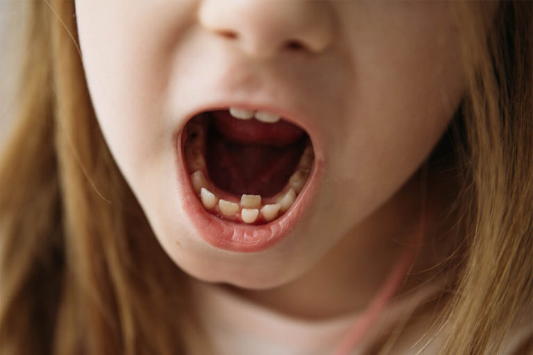 The mouth of a young child where adult teeth are growing in behind baby teeth