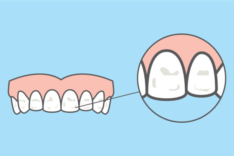 Illustration of a row of teeth with white spots where braces used to be