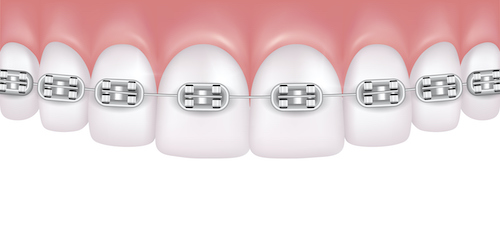 Illustration of a row of teeth with metal braces attached