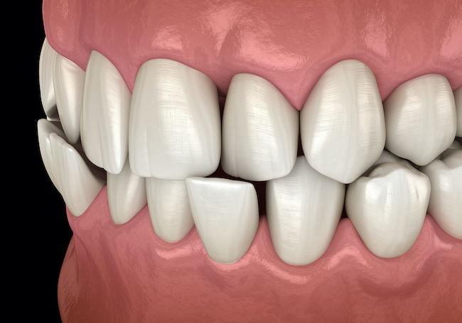 Illustration of teeth showing a crossbite