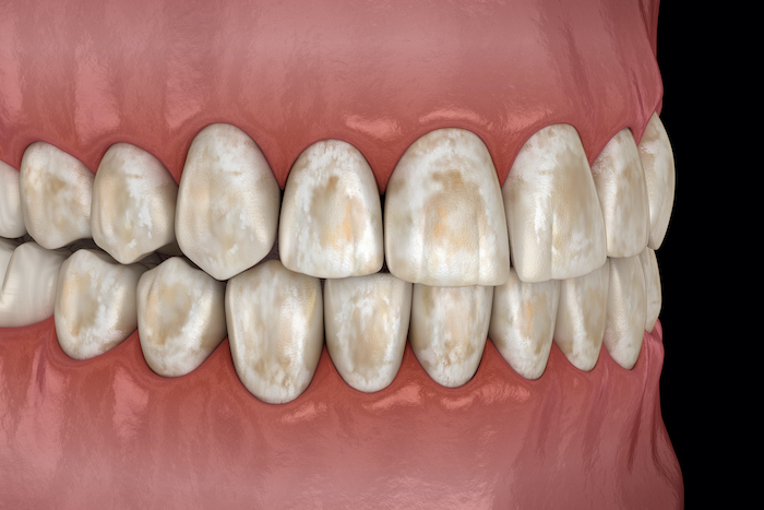 Illustration showing teeth with hypo spots requiring ICON resin infiltration treatment