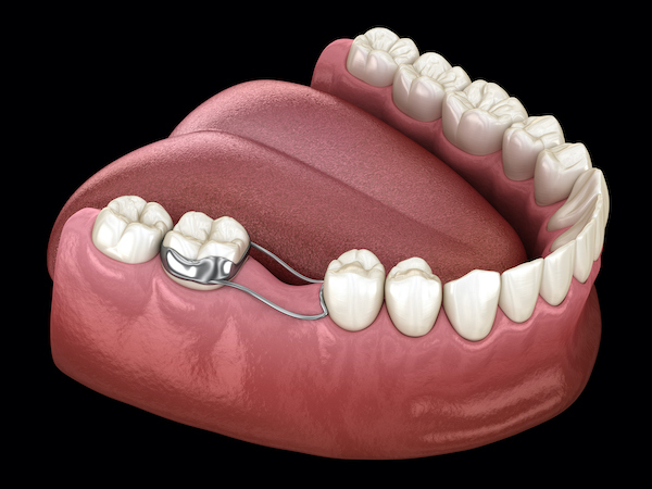 Illustration of a space maintainer attached to a molar to hold the space for an adult tooth