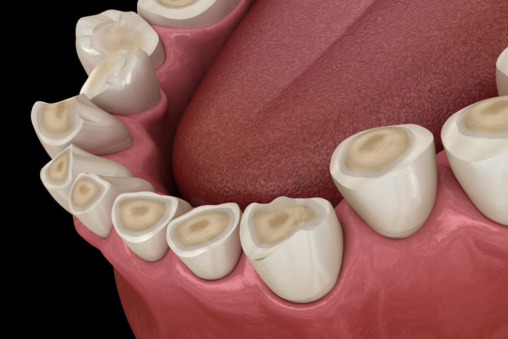 Illustration of chipped and cracked teeth after teeth grinding