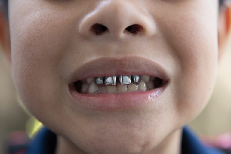 A young child smiling showing off silver diamine fluoride treatment on their front teeth