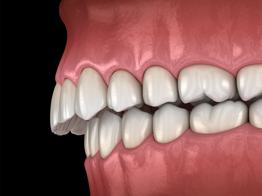 overbite correction