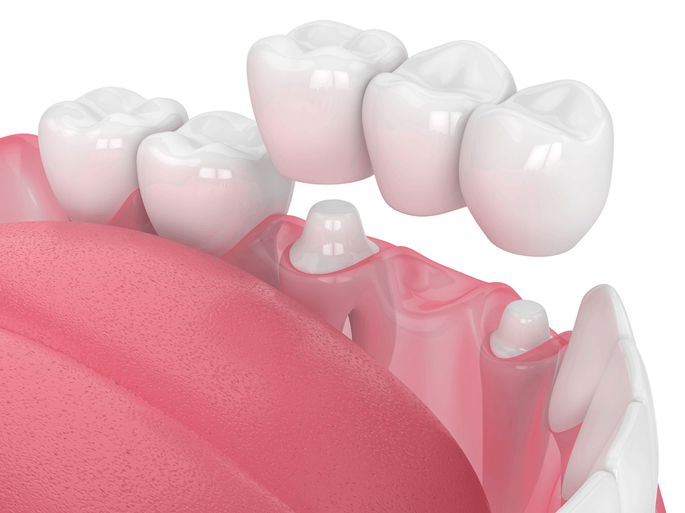 Dental Crowns