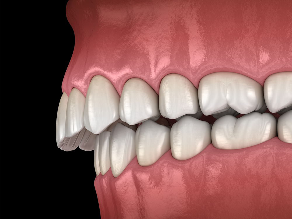 Overbite Correction
