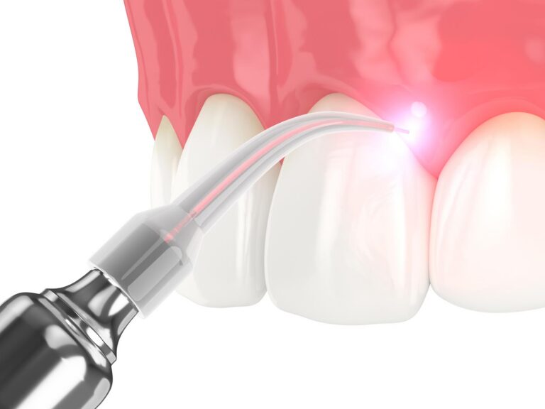 Soft tissue laser technology at Broad Smiles Pediatric Dentistry.