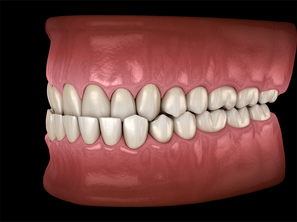 Underbite Correction